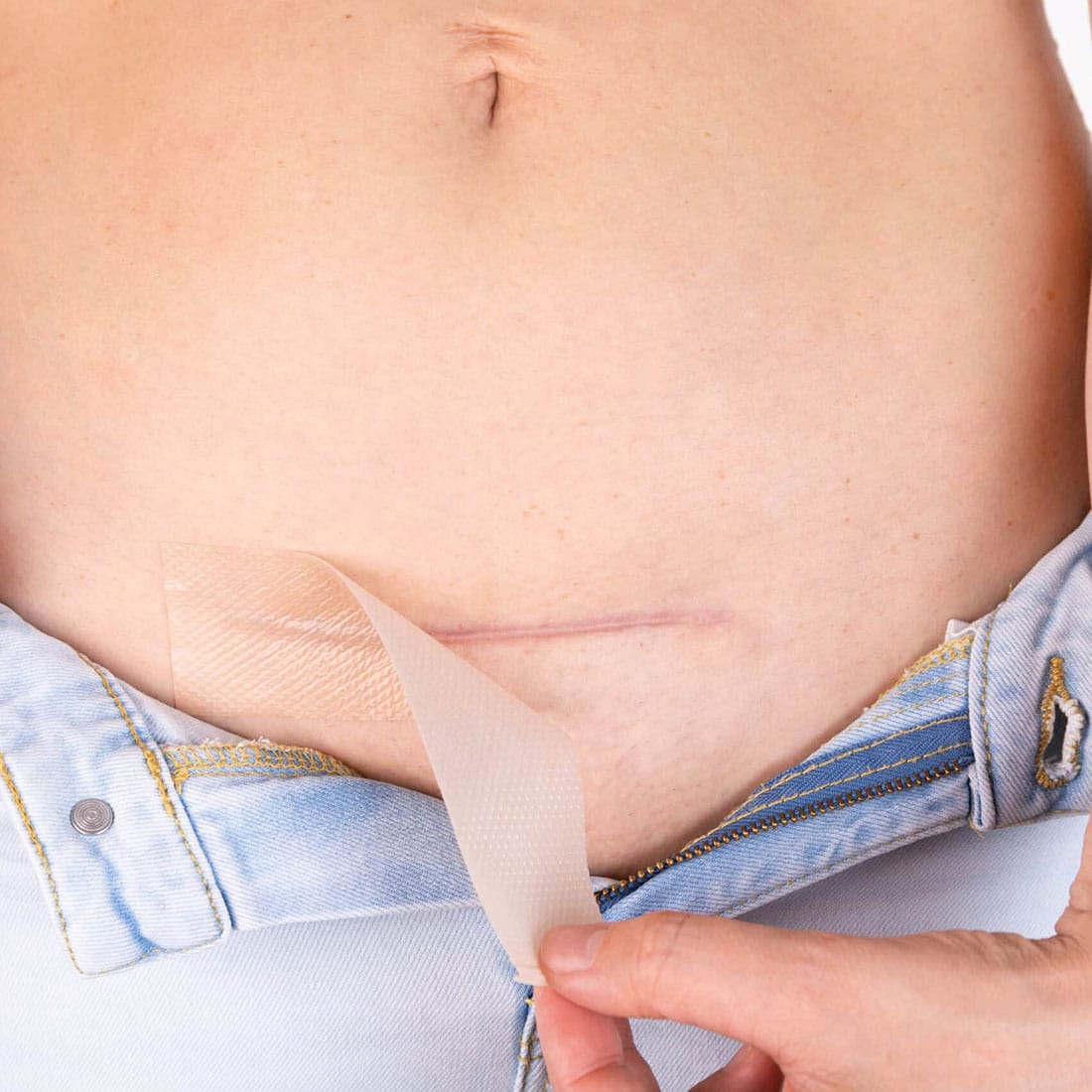 Kaloidon Patch: cerotti che favoriscono l’appiattimento delle cicatrici ipertrofiche e cheloidee.